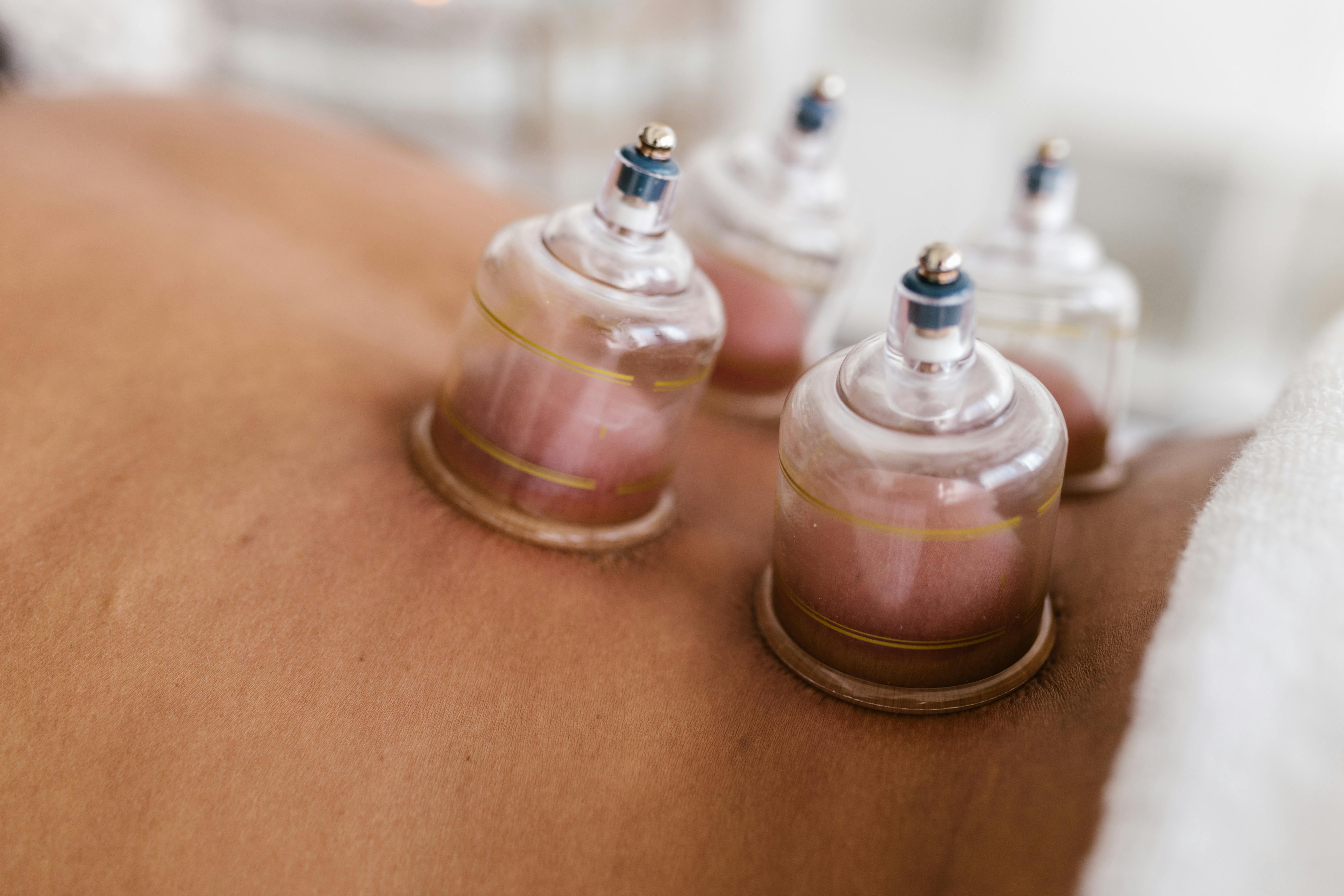Cupping Therapy